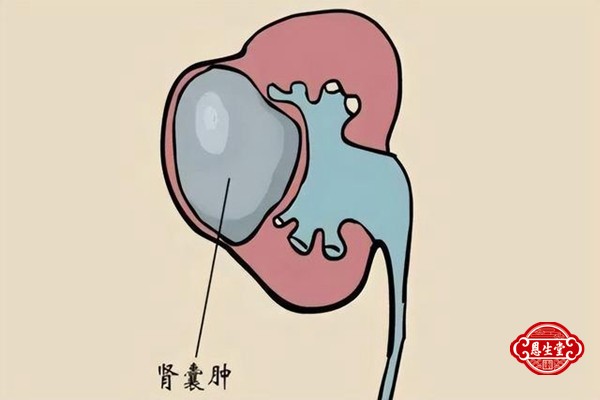 肾囊肿 (6)12.jpg
