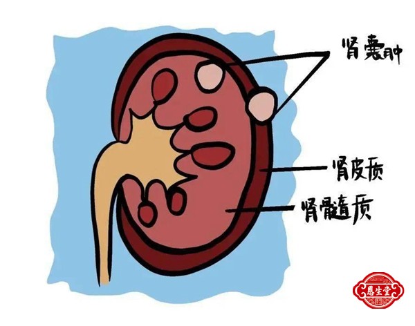 肾囊肿 (7)13.jpg