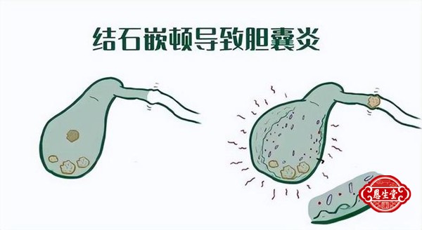 胆囊炎 (1)01.jpg
