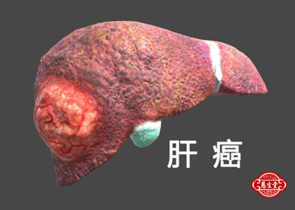 肝癌 (1)03.jpg