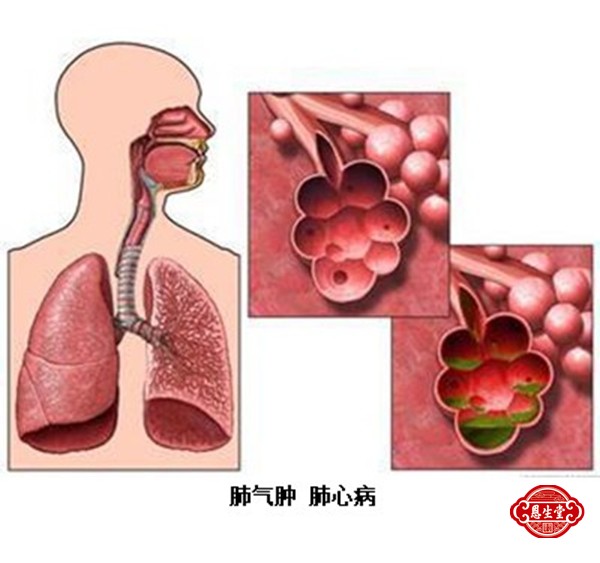 肺心病 (2)06.jpg