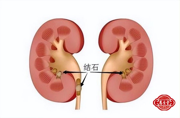 肾结石 (2)07.jpg