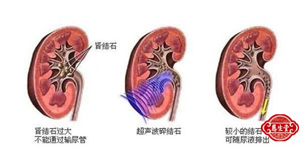 肾结石 (2)08.jpg