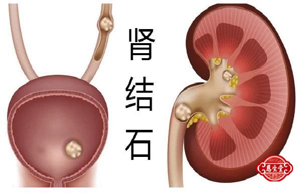 肾结石 (5)11.jpg