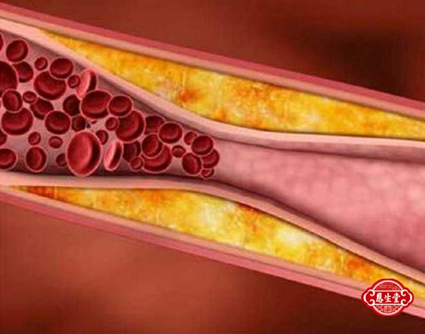 高血脂 (11)03.jpg
