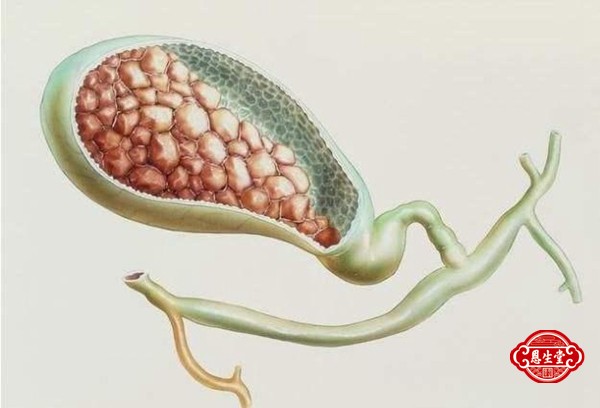 胆囊结石 (15)09.jpg