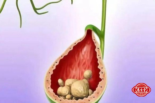 胆囊结石 (13)07.jpg