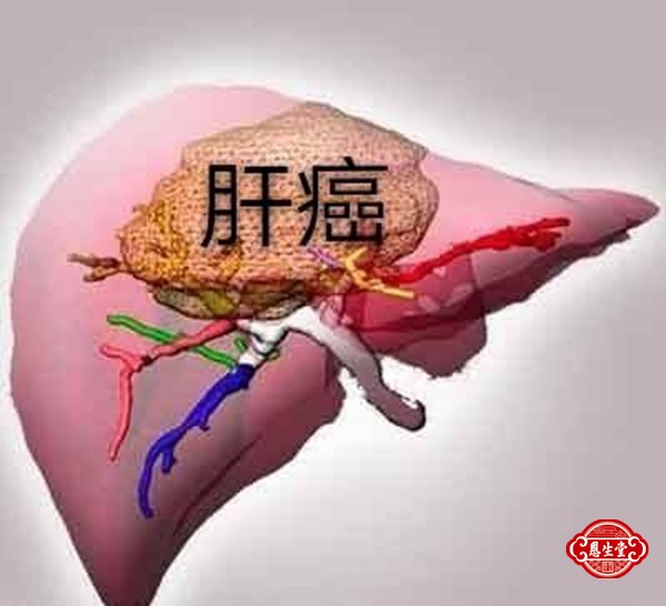 肝癌 (1)02.jpg