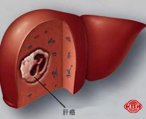 肝癌 (16)10.jpg