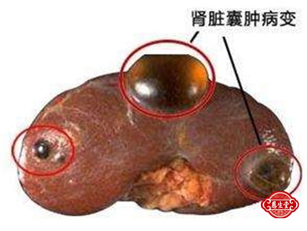 肾囊肿 (1)01.jpg