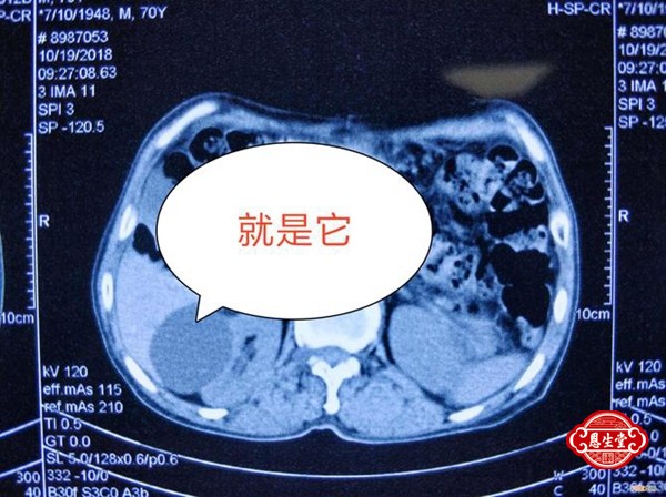 肾囊肿 (3)06.jpg