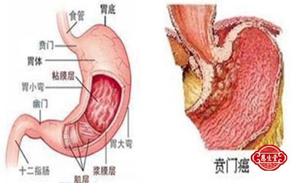 1721879759185877.jpg 贲门癌 (4)11.jpg