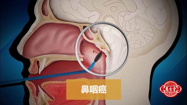 鼻咽癌 (5)14.jpg