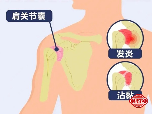 肩周炎 (1)03.jpg