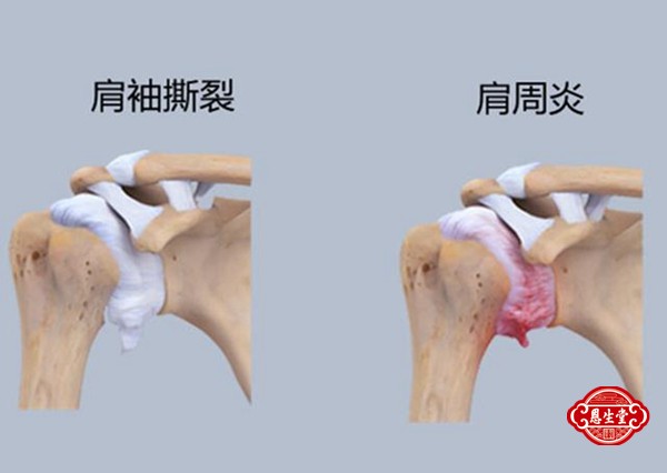 肩周炎 (3)13.jpg