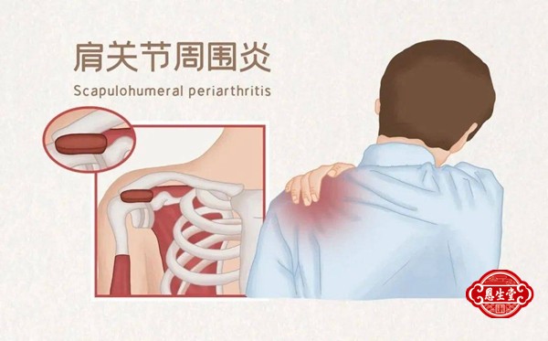 肩周炎27.jpg