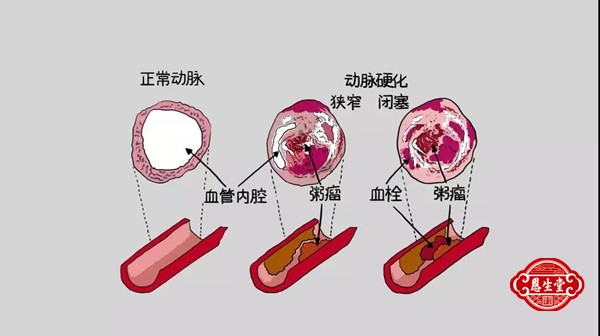 冠心病 (4)09.jpg
